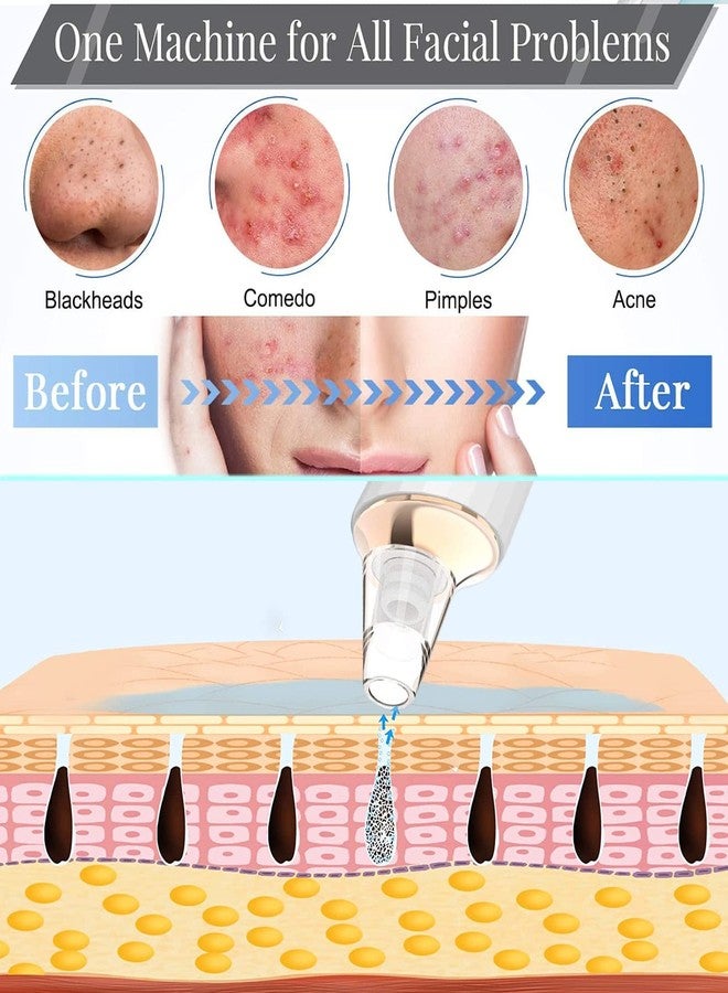 DIYthinker Blackhead Remover Pore Vacuum,Newest Upgraded USB Rechargeable Facial Pore Cleaner Blackhead Removal Kit with 3 Suction Power,5 Probes Black Head Extractions Tool for Women & Men - Image 5